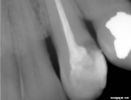 Γενική οδοντιατρική - απονεύρωση στα δόντια