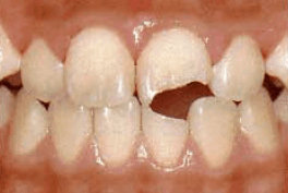 Ατύχημα στα δόντια