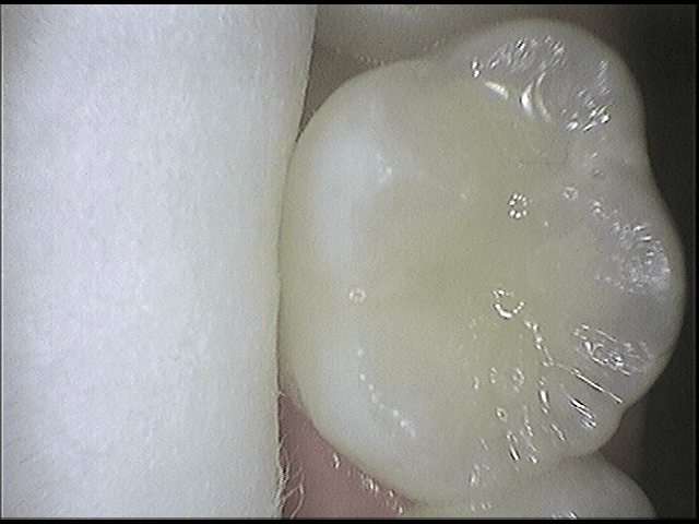 Γενική οδοντιατρική - σφραγισμα στα δόντια