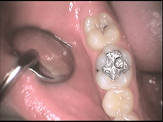Γενική οδοντιατρική - σφραγισμα στα δόντια