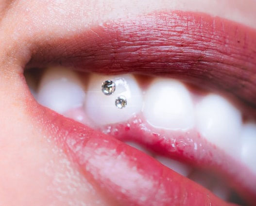 Οδοντικά κοσμήματα στο στόμα
