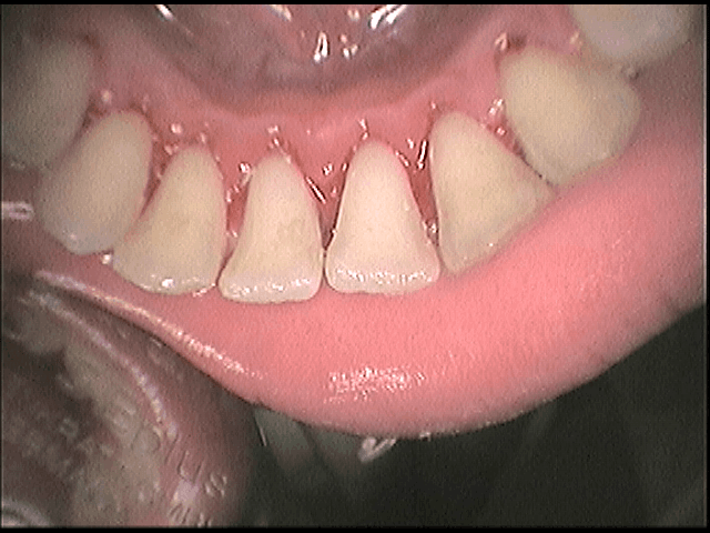 Αισθητική οδοντιατρική - καθαρισμός δοντιών