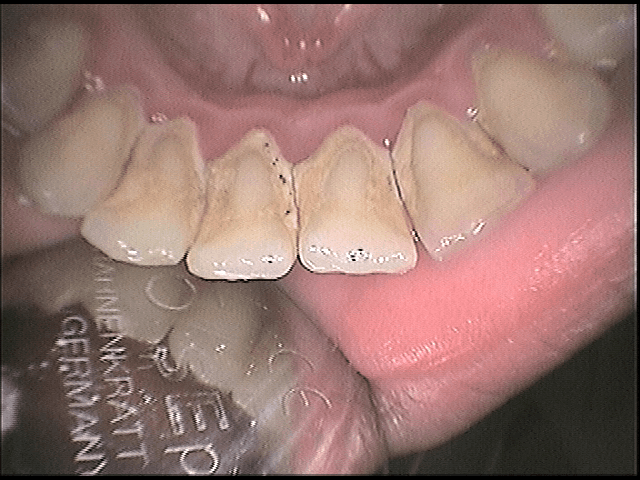 Αισθητική οδοντιατρική - καθαρισμός δοντιών