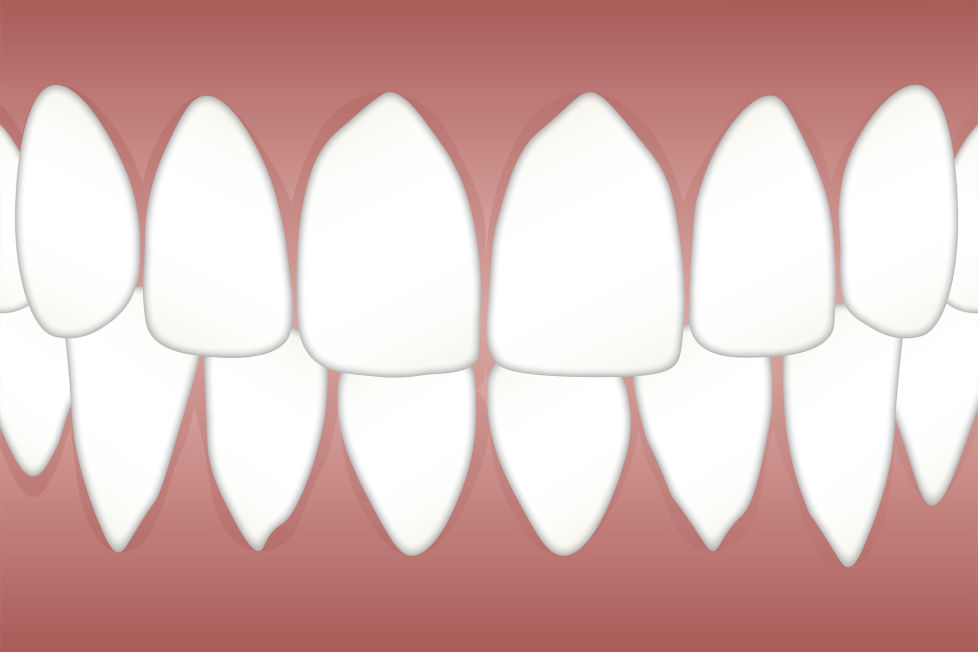 Δόντια που τρίζουν